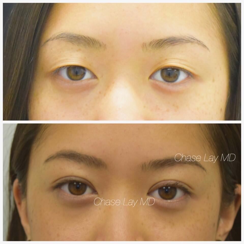 non incisional eyelid surgery cost
